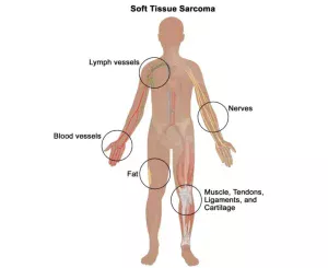 Soft Tissue Sarcoma Treatment