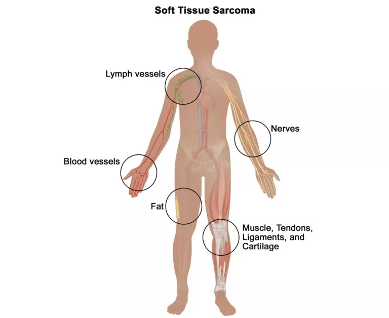 Soft Tissue Sarcoma Treatment