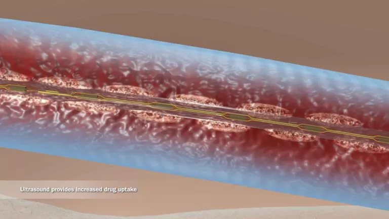 What is Thrombolysis?