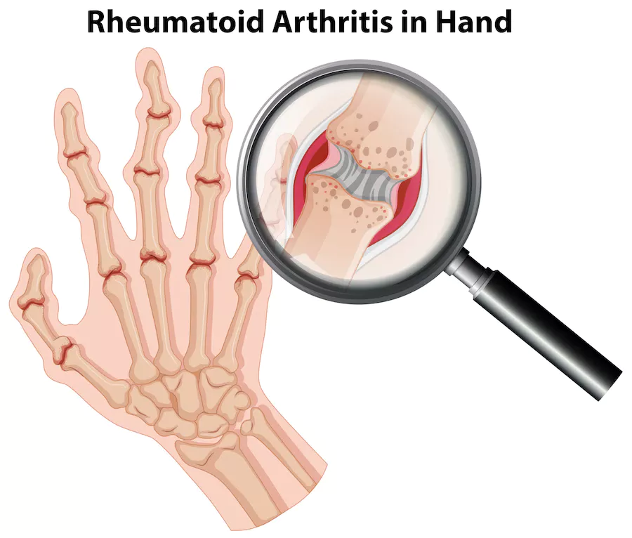 Rheumatoid arthritis in hand