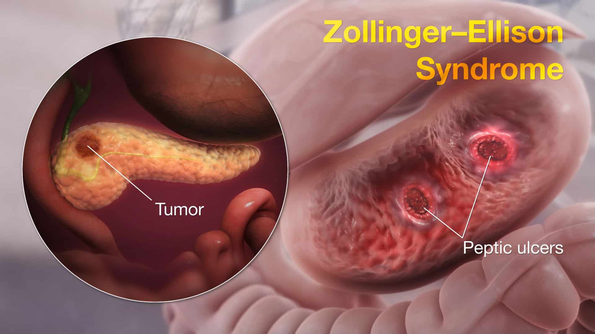 Zollinger-Ellison Syndrome