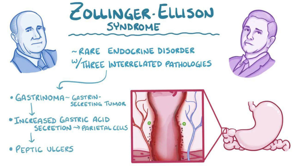 Zollinger-Ellison Syndrome