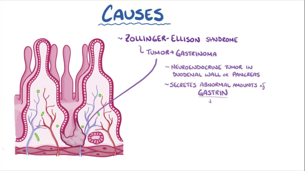 Zollinger-Ellison Syndrome Causes