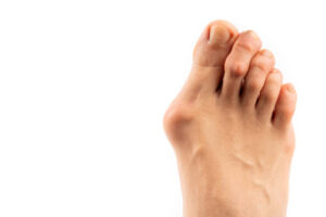 Bunion Basics Unmasking the Bulge