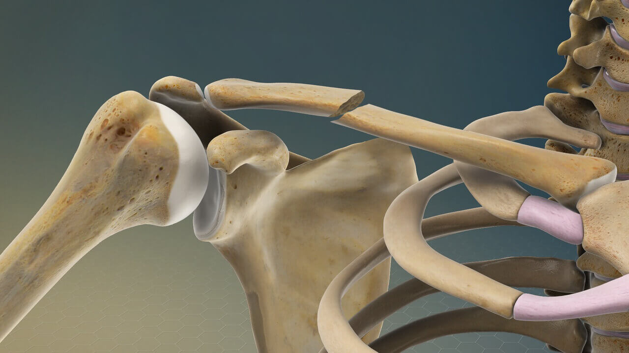 Clavicle Fracture