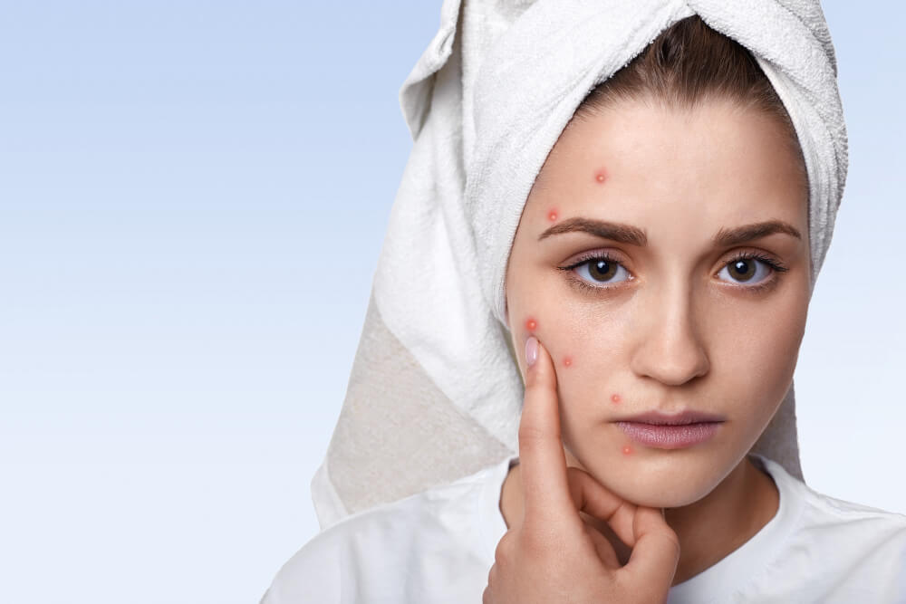 Demystifying Pimples