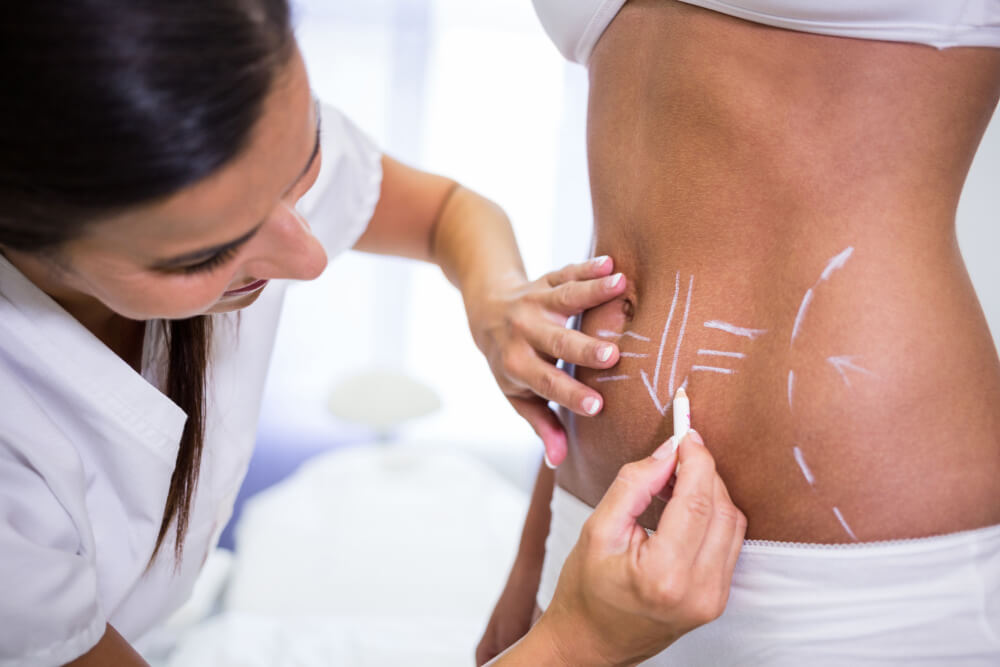 Understanding Liposuction and Laser Fat Removal
