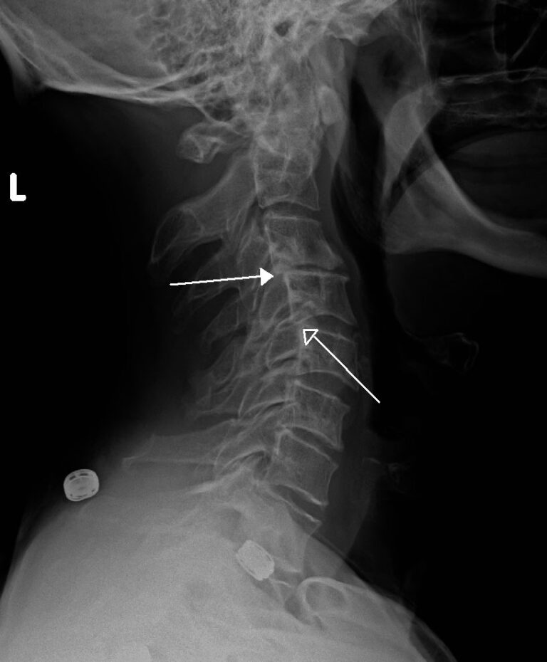 What Is Retrolisthesis What Are Its Symptoms Causes And Treatment