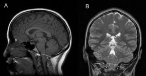 chiari-malformation