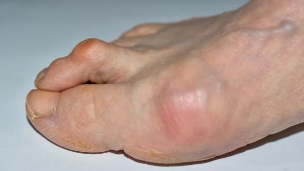 Hammer Toe