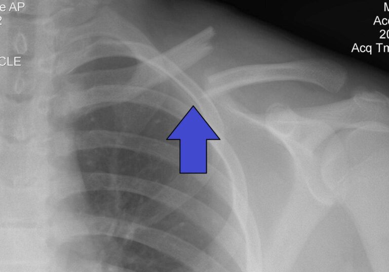 Clavicle Fracture (Broken Collarbone): Diagnosis, Treatment Options ...