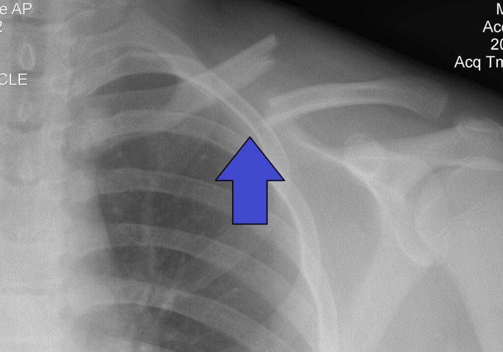 Clavicle Fracture (Broken Collarbone)