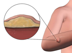 Soft Tissue Sarcoma