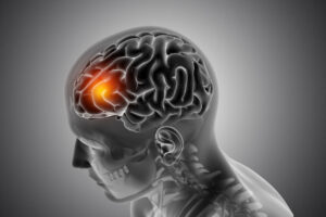 Speech Abnormalities and Stroke