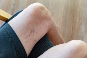 Understanding Varicose Veins