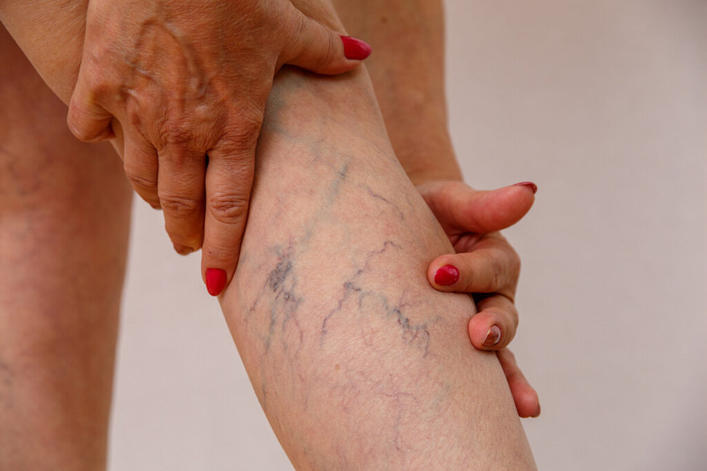 Understanding and Treating Spider Veins