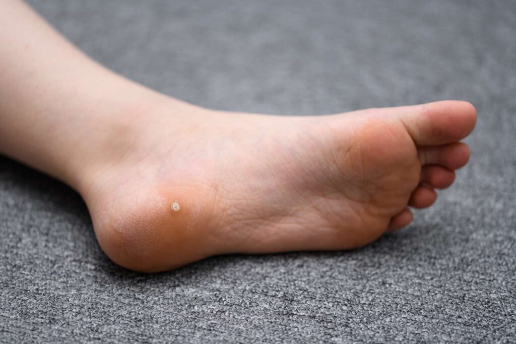 foot warts