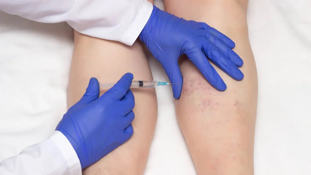 Sclerotherapy