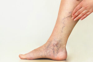 Understanding and Addressing Spider Veins