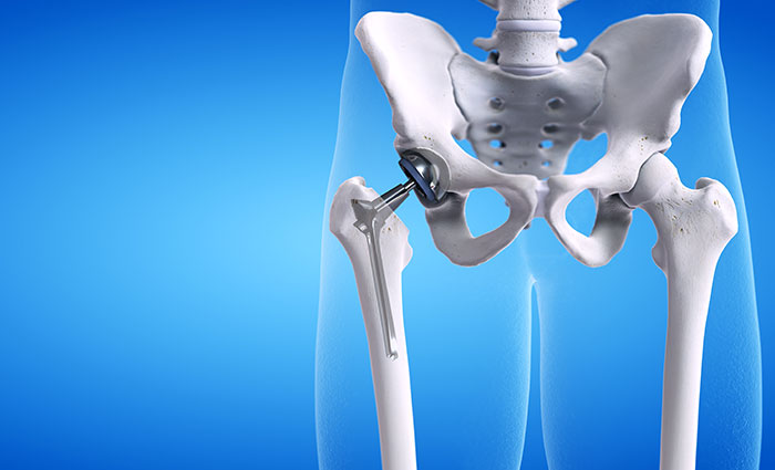 Orthopedic Doctor for Total Hip Replacement