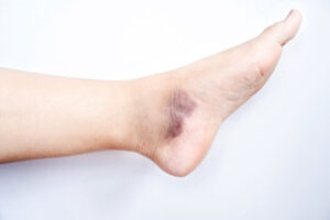 Foot Skin Discoloration A Podiatrist Care