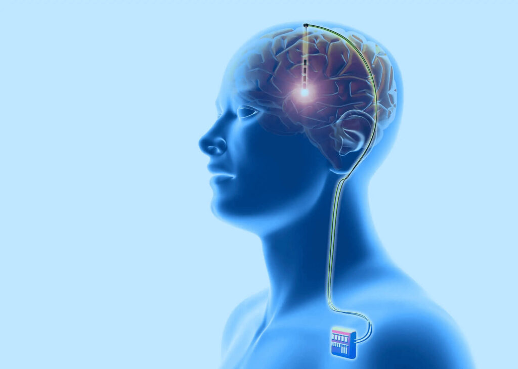 Deep Brain Stimulation