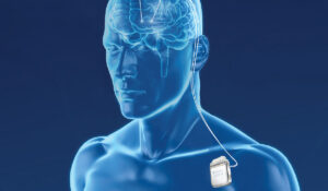 Deep Brain Stimulation