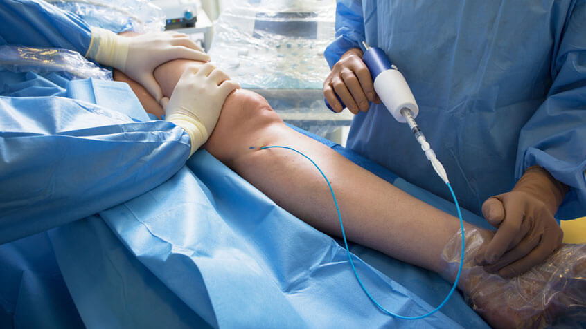 Vascular Surgeons For Enlarged Vein Treatment