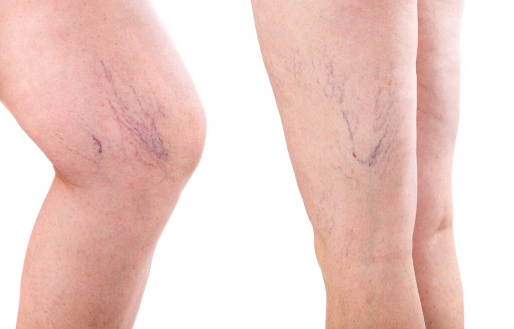 Vascular Surgeons Your Experts in Spider Vein Treatment