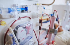 Hemodialysis A Lifeline for Kidney Disease Patients