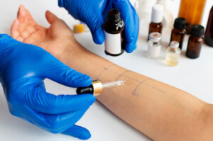  Skin Prick Test
