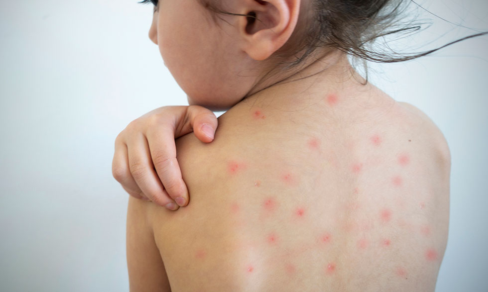 Measles Symptoms