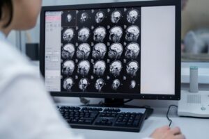 traumatic brain injury