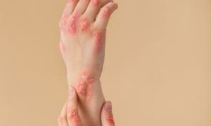 Burns, Cuts & Scrapes