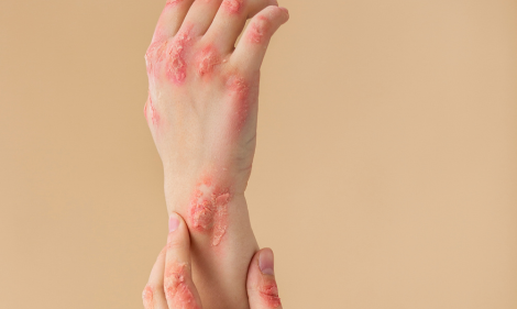 Burns, Cuts & Scrapes