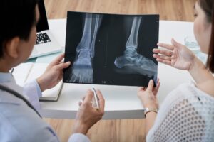 Treatment for Epiphysiolysis Fractures